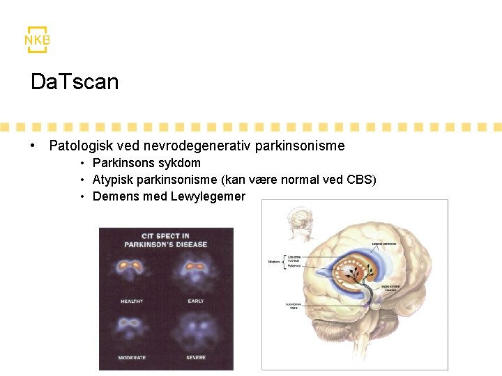 Da. Tscan • Patologisk ved nevrodegenerativ parkinsonisme • Parkinsons sykdom • Atypisk parkinsonisme (kan