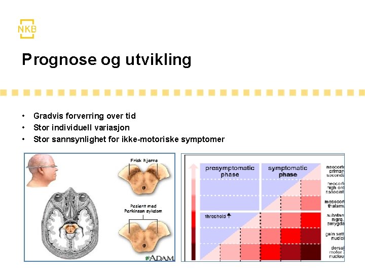 Prognose og utvikling • • • Gradvis forverring over tid Stor individuell variasjon Stor Prognose og utvikling • • • Gradvis forverring over tid Stor individuell variasjon Stor