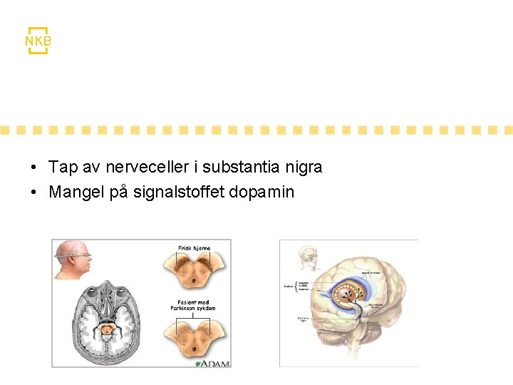  • Tap av nerveceller i substantia nigra • Mangel på signalstoffet dopamin 