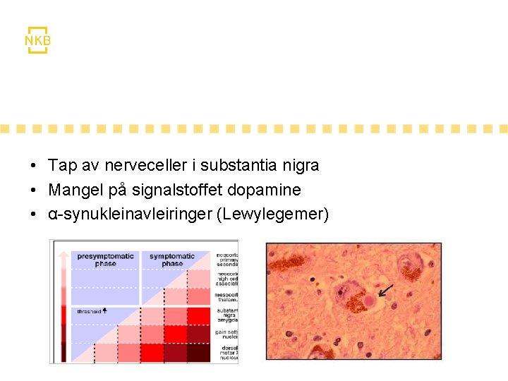• Tap av nerveceller i substantia nigra • Mangel på signalstoffet dopamine • • Tap av nerveceller i substantia nigra • Mangel på signalstoffet dopamine •