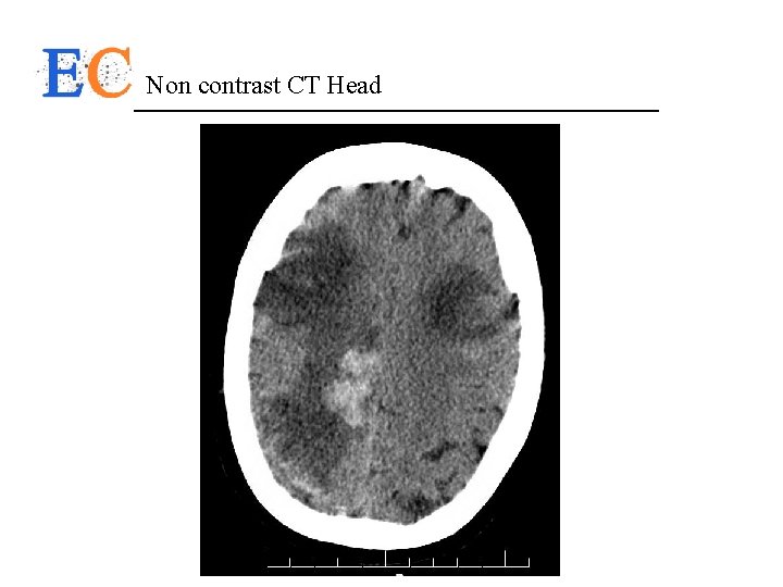 Non contrast CT Head 