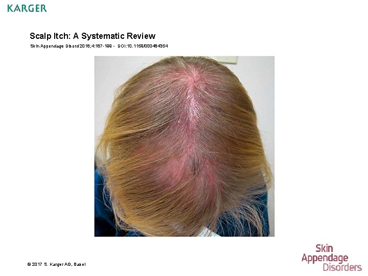 Scalp Itch: A Systematic Review Skin Appendage Disord 2018; 4: 187 -199 - DOI: