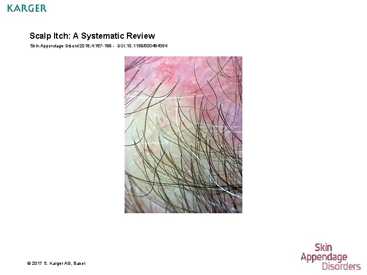 Scalp Itch: A Systematic Review Skin Appendage Disord 2018; 4: 187 -199 - DOI: