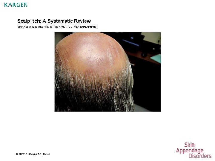 Scalp Itch: A Systematic Review Skin Appendage Disord 2018; 4: 187 -199 - DOI: