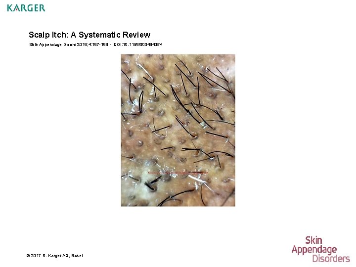 Scalp Itch: A Systematic Review Skin Appendage Disord 2018; 4: 187 -199 - DOI: