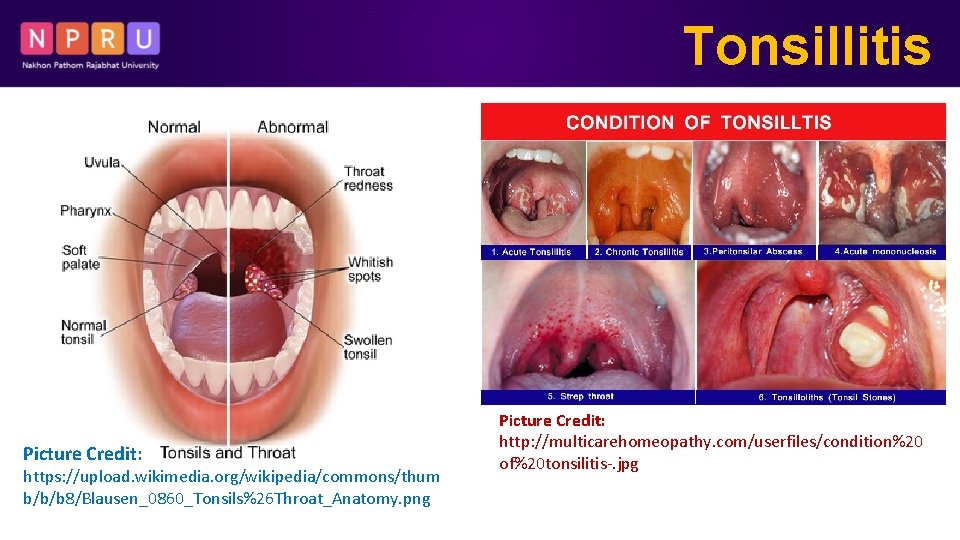 Tonsillitis Picture Credit: https: //upload. wikimedia. org/wikipedia/commons/thum b/b/b 8/Blausen_0860_Tonsils%26 Throat_Anatomy. png Picture Credit: http: