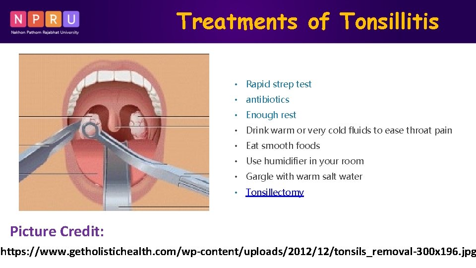 Treatments of Tonsillitis • Rapid strep test • antibiotics • Enough rest • Drink