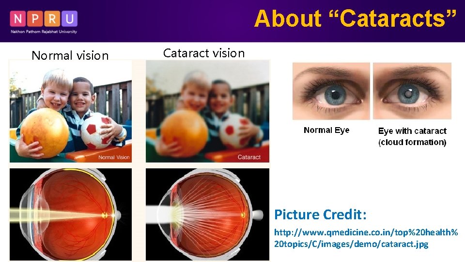 About “Cataracts” Normal vision Cataract vision Picture Credit: http: //www. qmedicine. co. in/top%20 health%