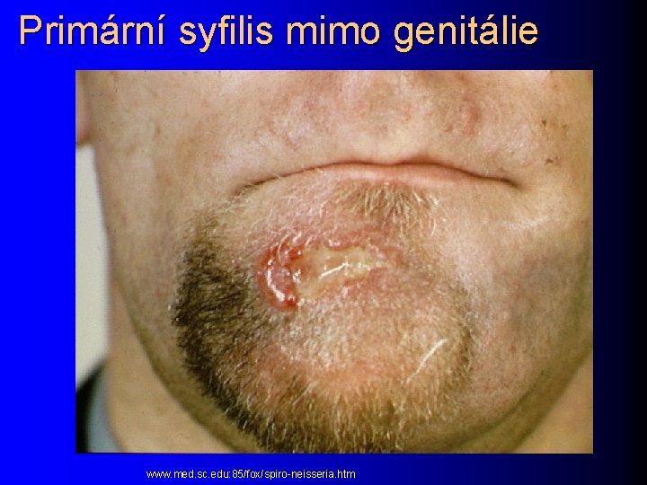 Primární syfilis mimo genitálie www. med. sc. edu: 85/fox/spiro-neisseria. htm 