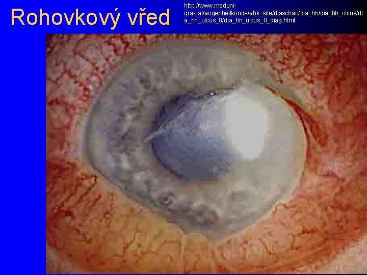 Rohovkový vřed http: //www. medunigraz. at/augenheilkunde/ahk_site/diaschau/dia_hh_ulcus/di a_hh_ulcus_8/dia_hh_ulcus_8_diag. html 