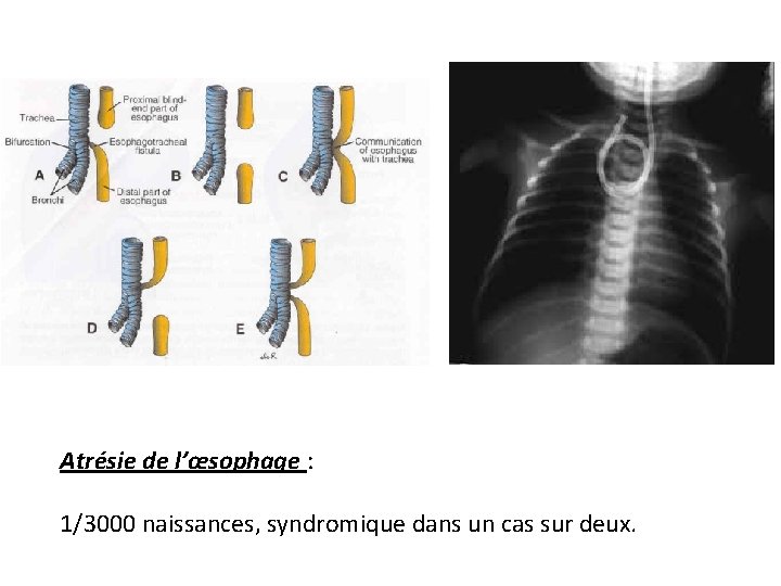 Atrésie de l’œsophage : 1/3000 naissances, syndromique dans un cas sur deux. 