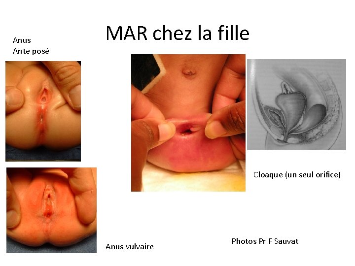 Anus Ante posé MAR chez la fille Cloaque (un seul orifice) Anus vulvaire Photos