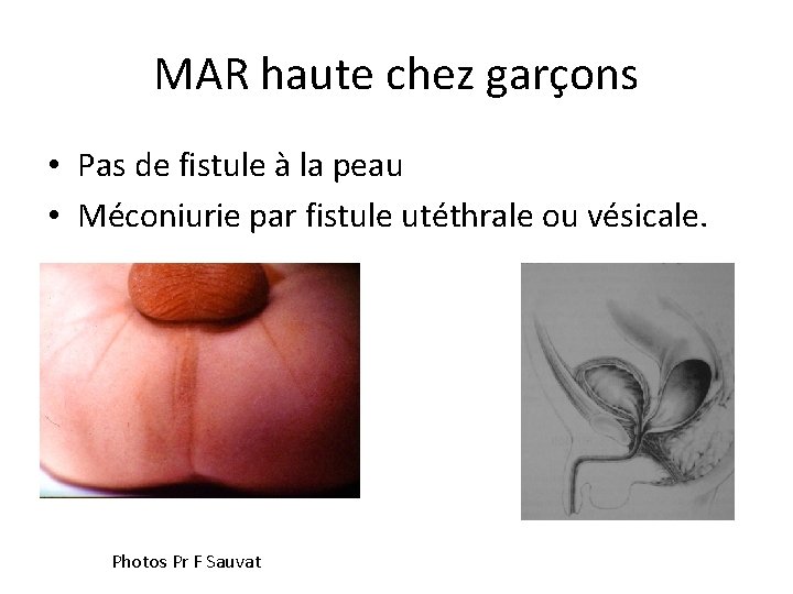 MAR haute chez garçons • Pas de fistule à la peau • Méconiurie par