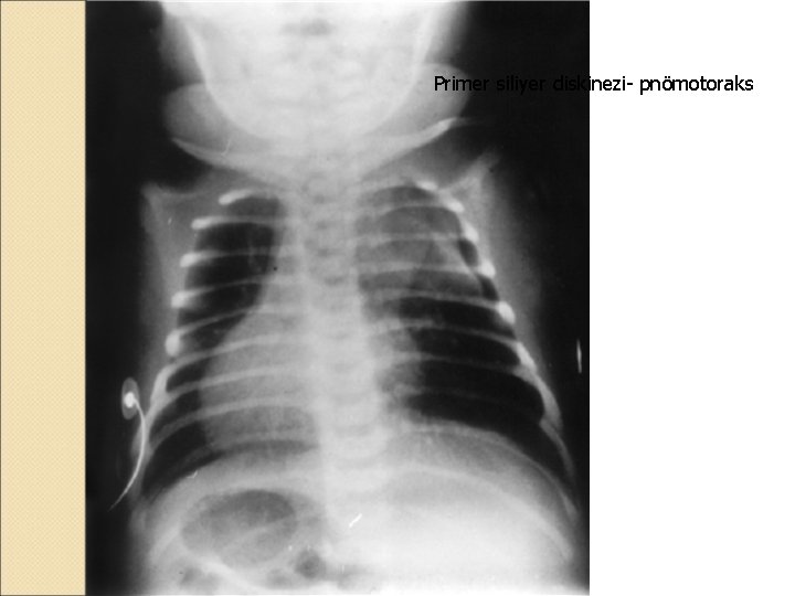 Primer siliyer diskinezi- pnömotoraks 