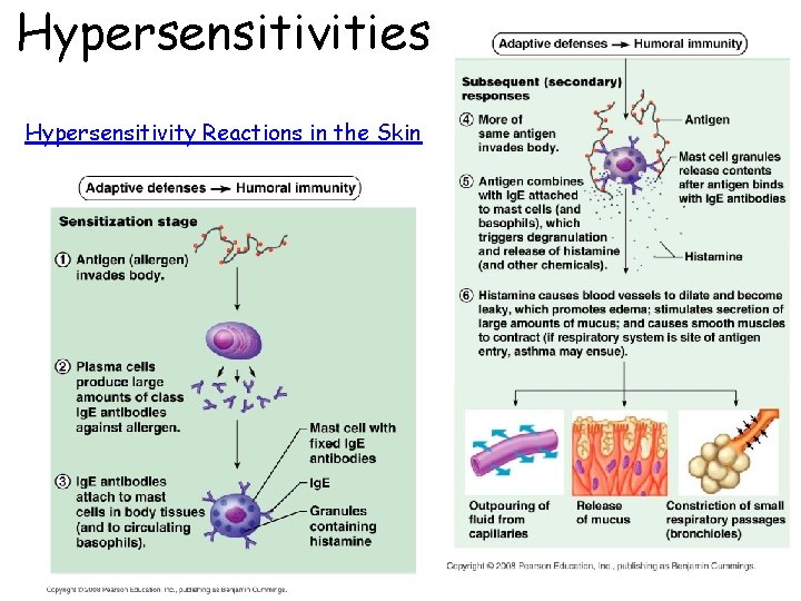 Hypersensitivities Hypersensitivity Reactions in the Skin 