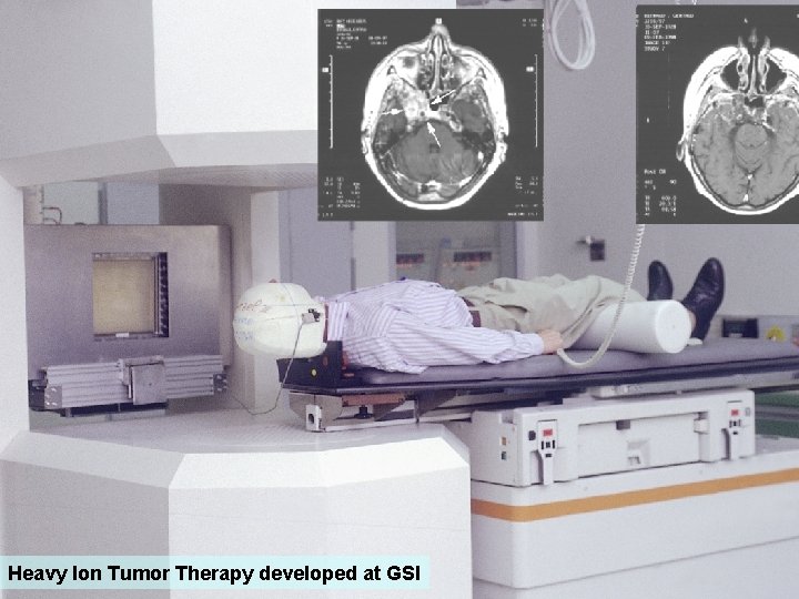 Heavy Ion Tumor Therapy developed at GSI 