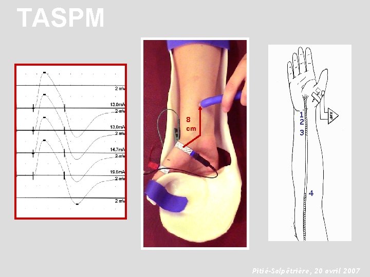 TASPM 8 cm 1 2 3 4 Pitié-Salpêtrière, 20 avril 2007 