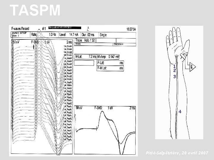 TASPM 1 2 3 4 Pitié-Salpêtrière, 20 avril 2007 
