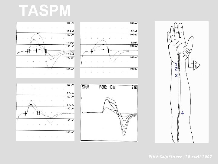 TASPM 1 2 3 4 Pitié-Salpêtrière, 20 avril 2007 