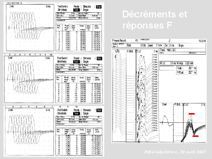 Décréments et réponses F Pitié-Salpêtrière, 20 avril 2007 