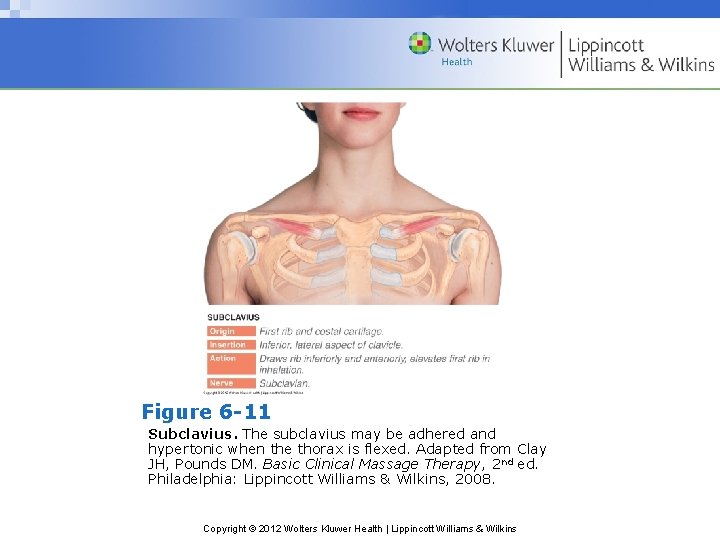 Figure 6 -11 Subclavius. The subclavius may be adhered and hypertonic when the thorax