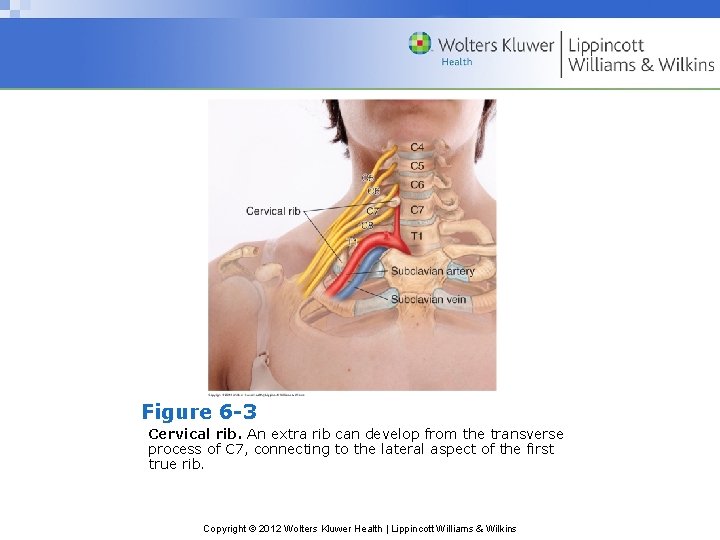 Figure 6 -3 Cervical rib. An extra rib can develop from the transverse process