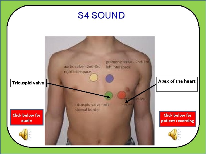 S 4 SOUND Tricuspid valve Click below for audio Apex of the heart Click