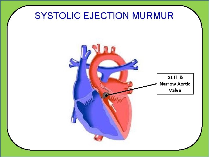 SYSTOLIC EJECTION MURMUR Stiff & Narrow Aortic Valve 