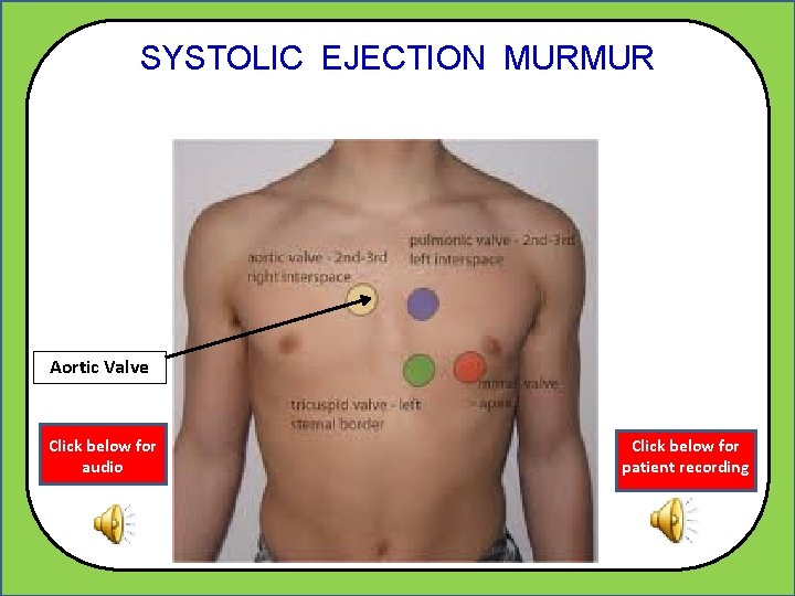 SYSTOLIC EJECTION MURMUR Aortic Valve Click below for audio Click below for patient recording