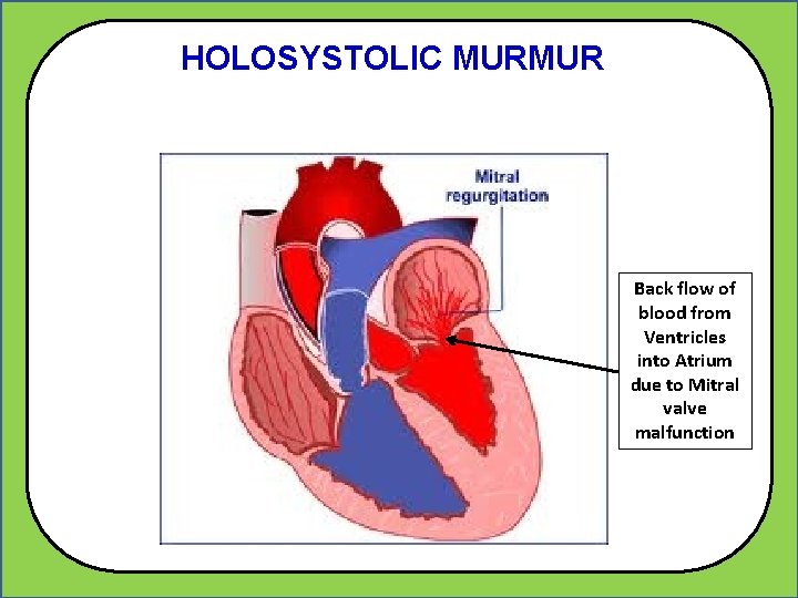 HOLOSYSTOLIC MURMUR Back flow of blood from Ventricles into Atrium due to Mitral valve