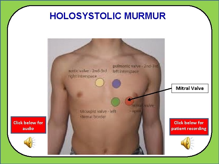 HOLOSYSTOLIC MURMUR Mitral Valve Click below for audio Click below for patient recording 