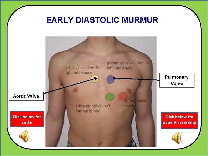 EARLY DIASTOLIC MURMUR z Pulmonary Valve Aortic Valve Click below for audio Click below