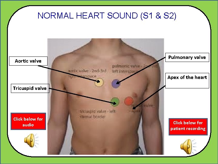 NORMAL HEART SOUND (S 1 & S 2) Aortic valve Pulmonary valve Apex of