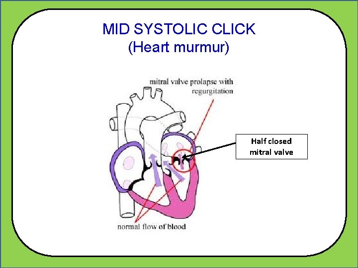 MID SYSTOLIC CLICK (Heart murmur) Half closed mitral valve 