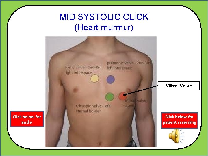 MID SYSTOLIC CLICK (Heart murmur) Mitral Valve Click below for audio Click below for