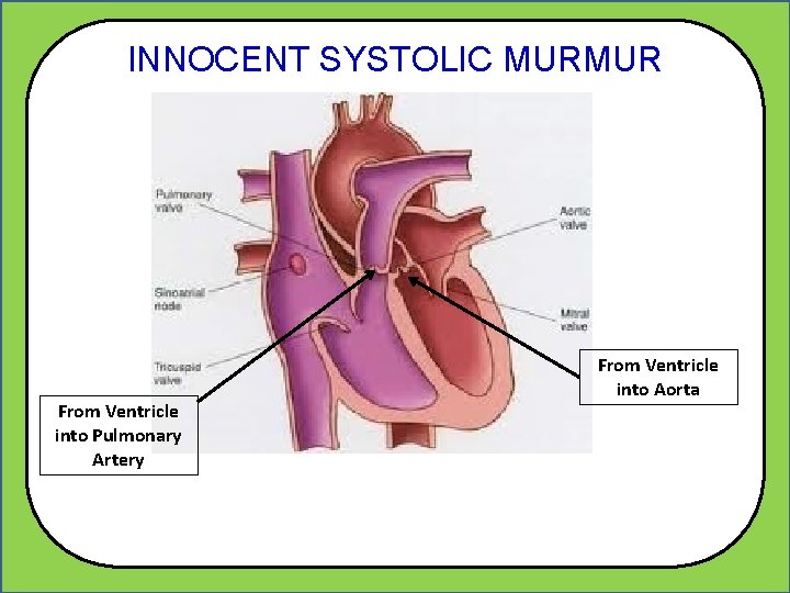 INNOCENT SYSTOLIC MURMUR From Ventricle into Pulmonary Artery From Ventricle into Aorta 