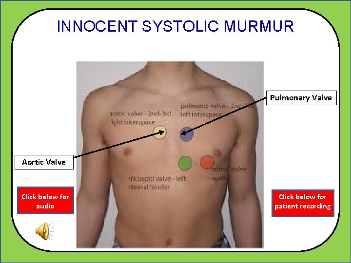 INNOCENT SYSTOLIC MURMUR Pulmonary Valve Aortic Valve Click below for audio Click below for