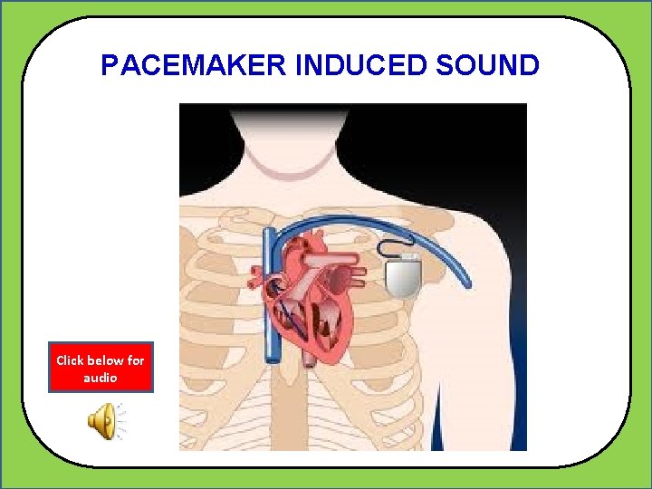 PACEMAKER INDUCED SOUND Click below for audio 