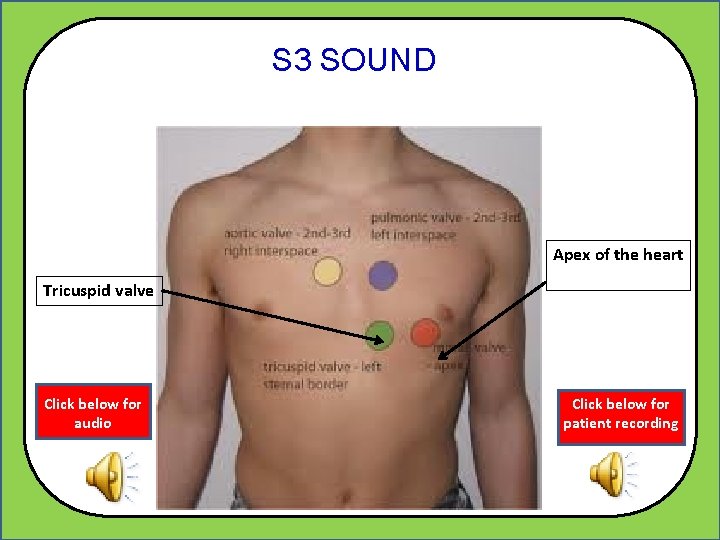 S 3 SOUND Apex of the heart Tricuspid valve Click below for audio Click