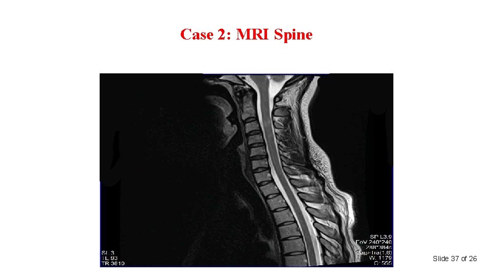 Case 2: MRI Spine Slide 37 of 26 