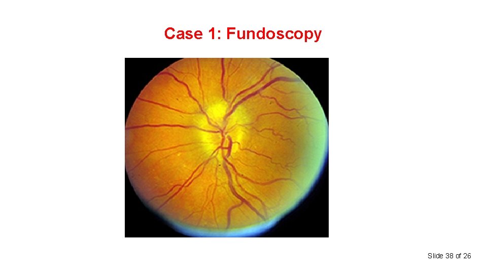 Case 1: Fundoscopy Slide 38 of 26 
