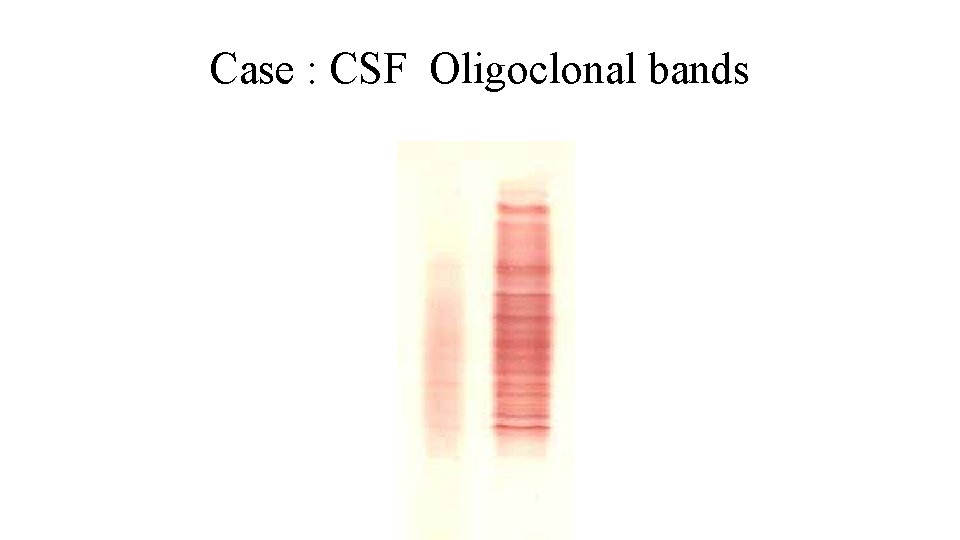 Case : CSF Oligoclonal bands 