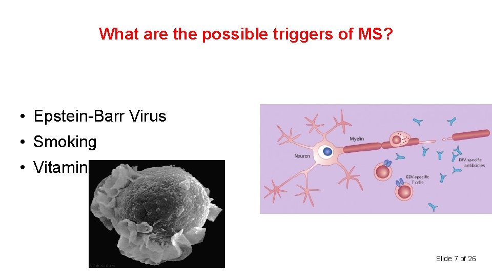 What are the possible triggers of MS? • Epstein-Barr Virus • Smoking • Vitamin-D