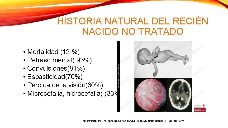 HISTORIA NATURAL DEL RECIÈN NACIDO NO TRATADO • Mortalidad (12 %) • Retraso mental(