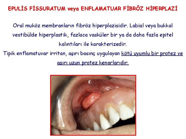 EPULİS FİSSURATUM veya ENFLAMATUAR FİBRÖZ HİPERPLAZİ Oral muköz membranların fibröz hiperplazisidir. Labial veya bukkal