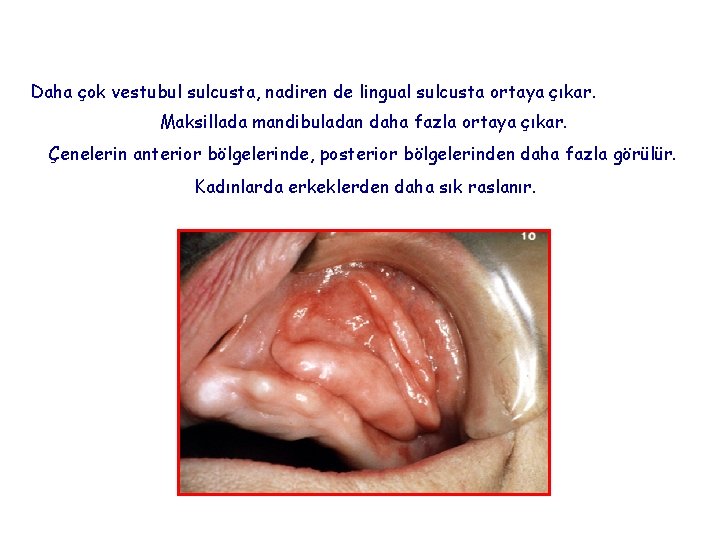 Daha çok vestubul sulcusta, nadiren de lingual sulcusta ortaya çıkar. Maksillada mandibuladan daha fazla