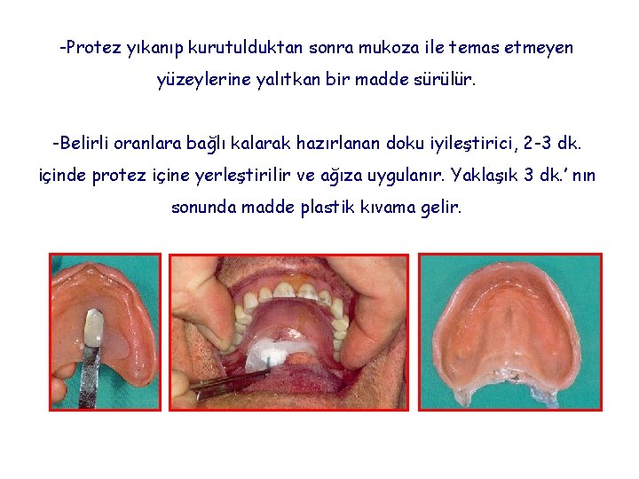 -Protez yıkanıp kurutulduktan sonra mukoza ile temas etmeyen yüzeylerine yalıtkan bir madde sürülür. -Belirli