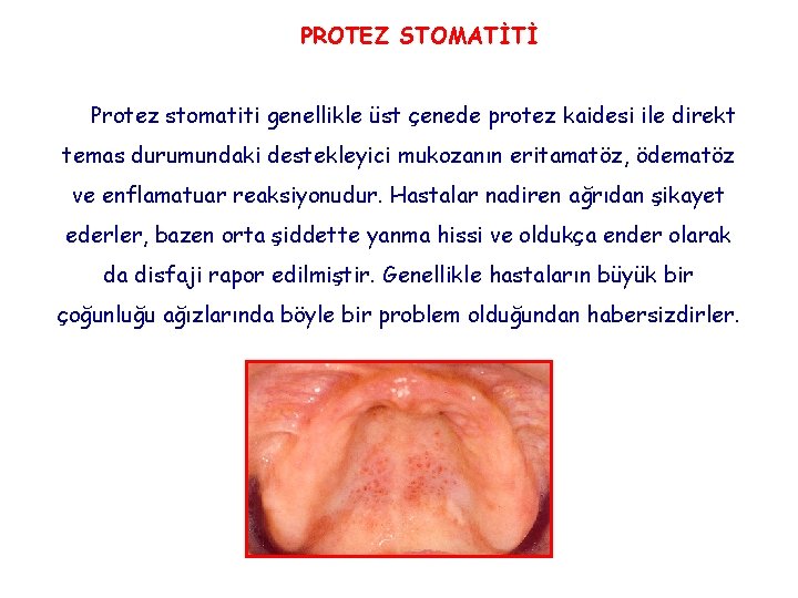 PROTEZ STOMATİTİ Protez stomatiti genellikle üst çenede protez kaidesi ile direkt temas durumundaki destekleyici