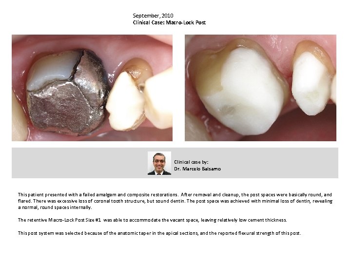 September, 2010 Clinical Case: Macro-Lock Post Clinical case by: Dr. Marcelo Balsamo This patient