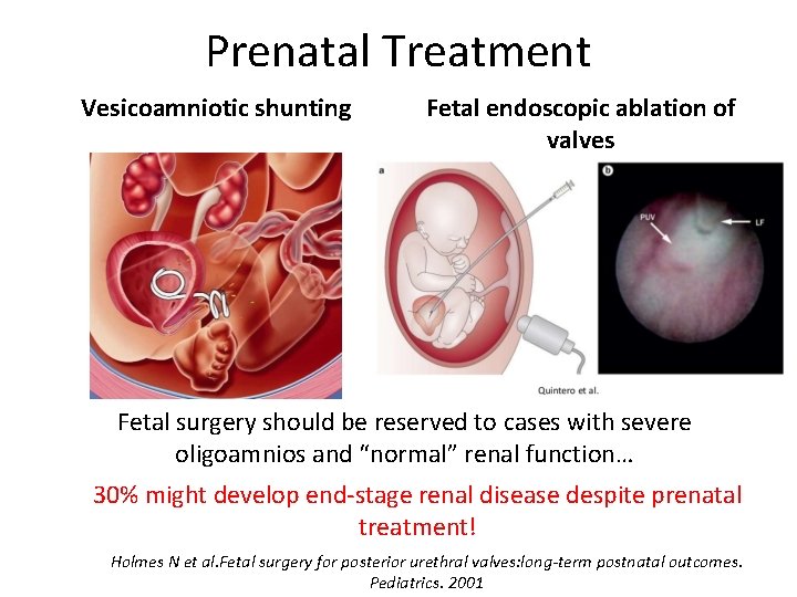 Prenatal Treatment Vesicoamniotic shunting Fetal endoscopic ablation of valves Fetal surgery should be reserved